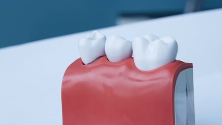 Dentists tooth plastic model with screw implant for teaching, learning and patients in dental office showing teeth and gums. Shallow dofの写真素材