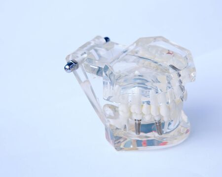Close up of a Dental implant model.