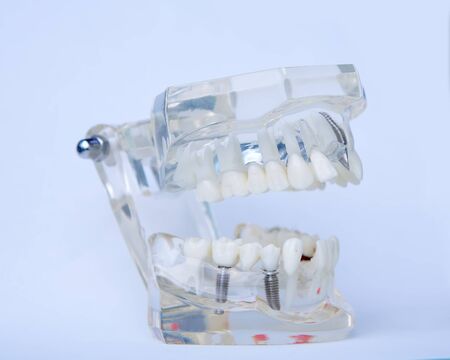 Dentists tooth plastic model with screw implant for teaching, learning and patients in dental office showing teeth and gums. Shallow dofの写真素材