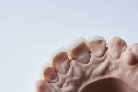 Ceramic dental veneers. Close-up view of dental layout of lower row of teeth prothesis on artificial...