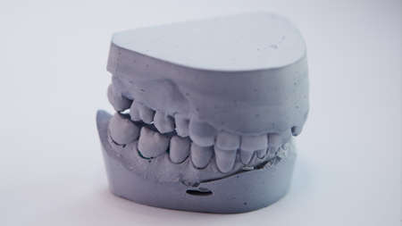 Dental casting gypsum model plaster cast stomatologic human jaws prothetic laboratory, technical...