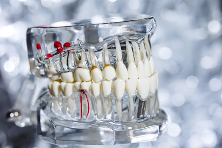Dental tooth implant titanium prosthetic dentists model.の写真素材