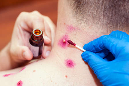 sores on the skin of a person.の写真素材