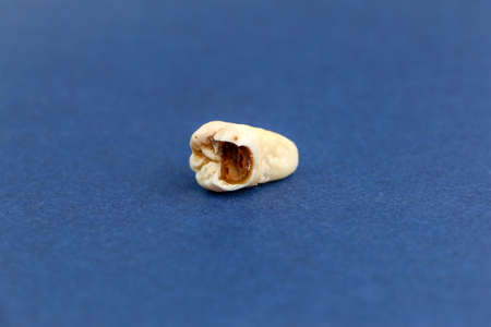 Close up of a removed sore tooth. Toothache. High quality photo