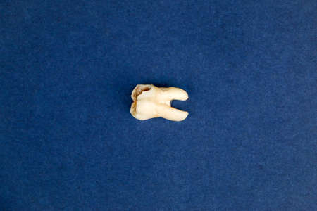 Close up of a removed sore tooth. Toothache. High quality photo
