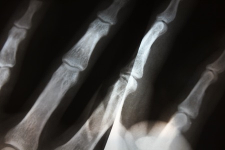 x-ray image of human body parts, x-ray picture, roentgenの写真素材