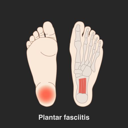 Vector hand drawn flat illustration plantar fasciitis infographic for medical studies. Isolated on black background.のイラスト素材