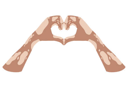 Hands with vitiligo disease. Support for people with skin pigmentation disorders. Heart, self-love and body positive. Light skin, mutalka. Body positive. Hand drawn illustration. Vectorのイラスト素材