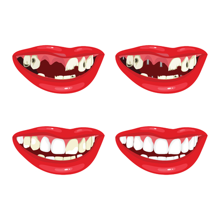 Dental restoration. Beautiful smile after dental treatmentのイラスト素材