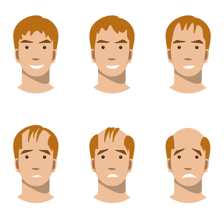 Stages of hair loss and hair treatmentのイラスト素材