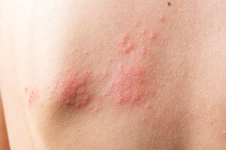 Skin infected Herpes zoster virus. Herpes Virus on body. urticaria rash. atopic dermatitis on body.の写真素材