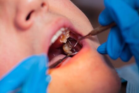 Dentist treatment a patient's teeth in the dentistの写真素材