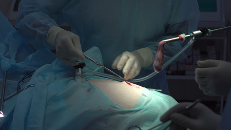 Operation using laparoscopic equipment. Surgeons team. Hospital.の写真素材
