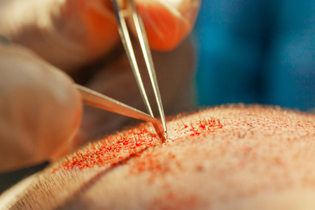 Macrophotography of a hair bulb transplanted into a hairless area. Baldness treatment. Hair transplant. Surgeons in the operating room carry out hair transplant surgery. Surgical technique that moves hair follicles from a part of the head.の写真素材