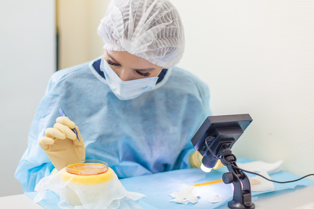 The doctor under the microscope recalculates the hair follicles. Baldness treatment. Hair transplant. Surgeons in the operating room carry out hair transplant surgery. Surgical technique that moves hair follicles from a part of the head.の写真素材