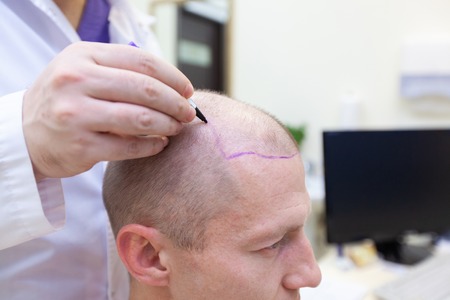 Baldness treatment. Patient suffering from hair loss in consultation with a doctor. Preparation for hair transplant surgery. The line marking the growth of hair. The patient controls the marking in the mirrorの写真素材