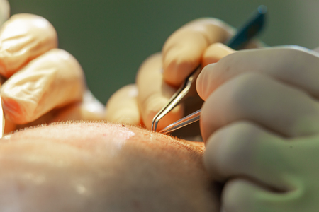 Macrophotography of a hair bulb transplanted into a hairless area. Baldness treatment. Hair transplant. Surgeons in the operating room carry out hair transplant surgery. Surgical technique that moves hair follicles from a part of the head.の写真素材