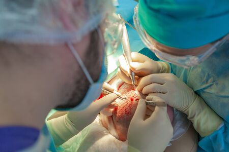 Baldness treatment. Hair transplant. Surgeons in the operating room carry out hair transplant surgery. Surgical technique that moves hair follicles from a part of the head.の写真素材