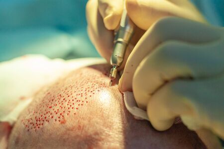 Patients head close-up. Baldness treatment. Hair transplant. Surgeons in the operating room carry out hair transplant surgery. Surgical technique that moves hair follicles from a part of the head.の写真素材