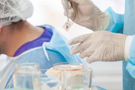 Baldness treatment. Hair transplant. Surgeons in the operating room carry out hair transplant surgery. Surgical technique that moves hair follicles from a part of the head.の写真素材