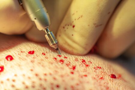 Patients head close-up. Baldness treatment. Hair transplant. Surgeons in the operating room carry out hair transplant surgery. Surgical technique that moves hair follicles from a part of the head.の写真素材