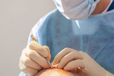 Baldness treatment. Hair transplant. Surgeons in the operating room carry out hair transplant surgery. Surgical technique that moves hair follicles from a part of the head.の写真素材
