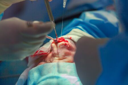 Surgeon and his assistant performing cosmetic surgery on nose in hospital operating room. Nose...