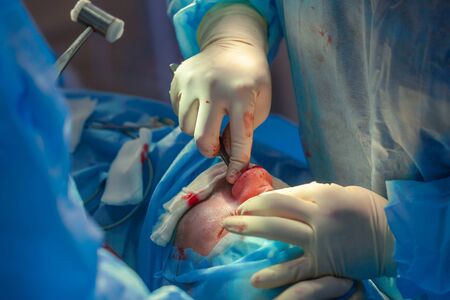Surgeon and his assistant performing cosmetic surgery on nose in hospital operating room. Nose reshaping, augmentation. Rhinoplasty.の写真素材