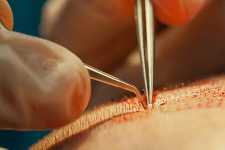 Macrophotography of a hair bulb transplanted into a hairless area. Baldness treatment. Hair...