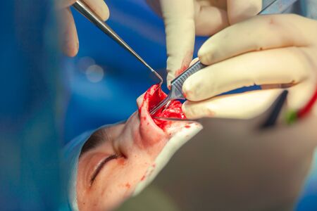 Surgeon and his assistant performing cosmetic surgery on nose in hospital operating room. Nose reshaping, augmentation. Rhinoplasty.の写真素材