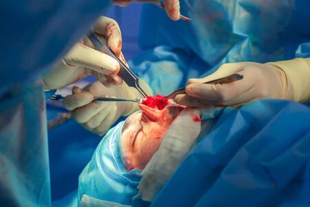 Surgeon and his assistant performing cosmetic surgery on nose in hospital operating room. Nose reshaping, augmentation. Rhinoplasty.の写真素材