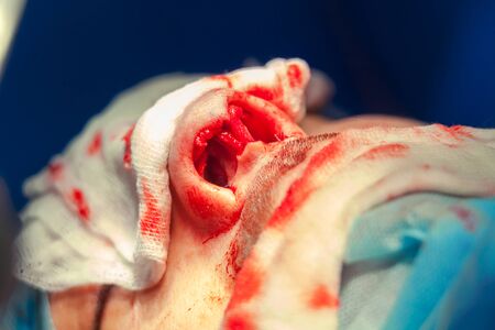 Surgeon and his assistant performing cosmetic surgery on nose in hospital operating room. Nose reshaping, augmentation. Rhinoplasty.の写真素材