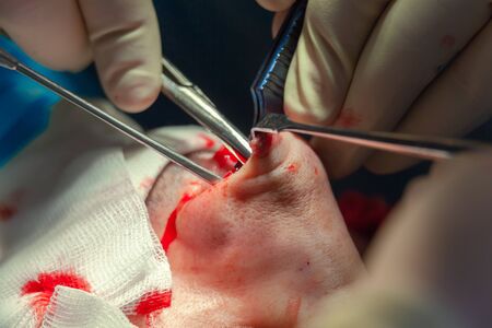 Surgeon and his assistant performing cosmetic surgery on nose in hospital operating room. Nose reshaping, augmentation. Rhinoplastyの写真素材