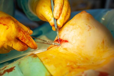 Hospital. Surgeon operates in the operating room. The surgeon puts a suture on the incision finishing the breast augmentation operationの写真素材