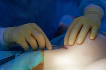 Hospital. Surgeon operates in the operating room. Close up of the surgeon's hands examining the suture on the patient's breast after plastic surgery.の写真素材