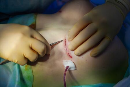 Hospital. Surgeon operates in the operating room. Close up of the surgeons hands examining the...