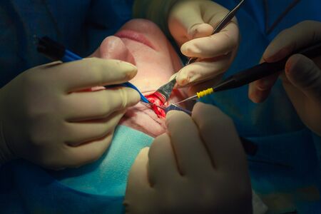 Close up of the face of a patient who is undergoing blepharoplasty. The surgeon cuts the eyelid and performs manipulations using medical instrumentsの写真素材