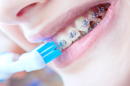 Beautiful smiling girl with retainer for teeth brushing teeth.の写真素材