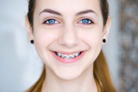 Teeth with braces.の写真素材