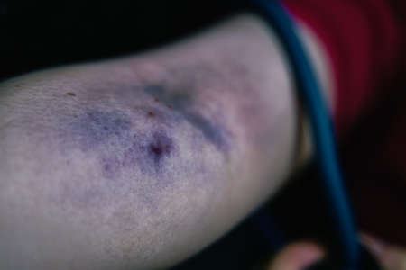 Womans arm is bruised from taking intravenous narcotic. Drug addict pulls tourniquet on arm. Large blood hematoma close-up. Concept of despair and depression. Addiction to illegal substances.の写真素材