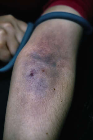 Drug addict pulls tourniquet on arm. Large blood hematoma close-up. Womans arm is bruised from taking intravenous narcotic. Concept of despair and depression. Addiction to illegal substances.の写真素材