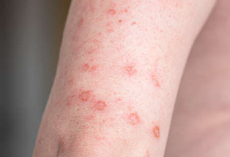 Close-up body with allergic rash, eczema on hands, skin with red bumps and blisters