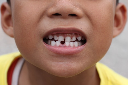Asian boy smile with decayed teethの写真素材