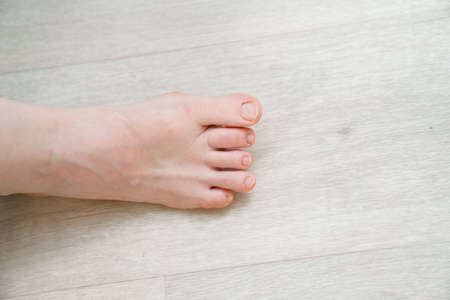 unusual foot. very small little finger on the leg. orthopedic abnormalities.の写真素材