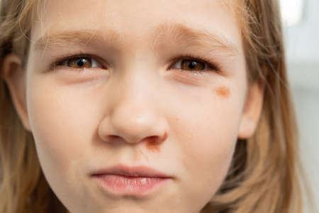 Portrait girl with an abrasion under her eye. child abuse. wounds and abrasionsの写真素材