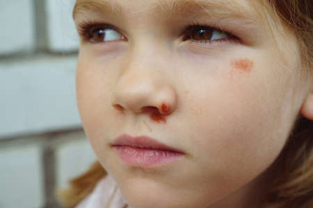 Portrait girl with an abrasion under her eye. child abuse. wounds and abrasionsの写真素材