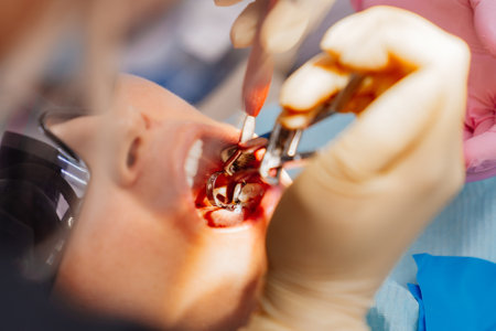 real. dentist pulls out a sick wisdom tooth.の写真素材
