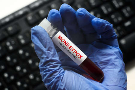 Monkeypox test tube in doctors hand in lab, medical worker holding blood sample for smallpox virus...