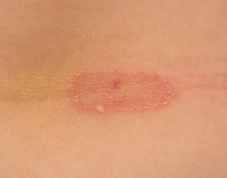 Ringworm of the skin. macro