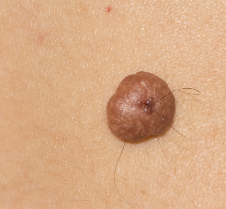 a mole on the skin. macroの写真素材
